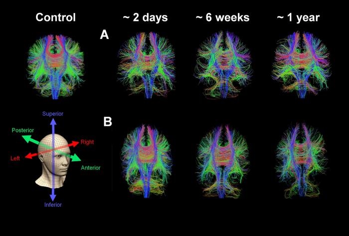 Image: Whole brain diffusion tensor tractography in an age-matched control subject and two patients with serial images (Photo courtesy of Virginia Newcombe/University of Cambridge)